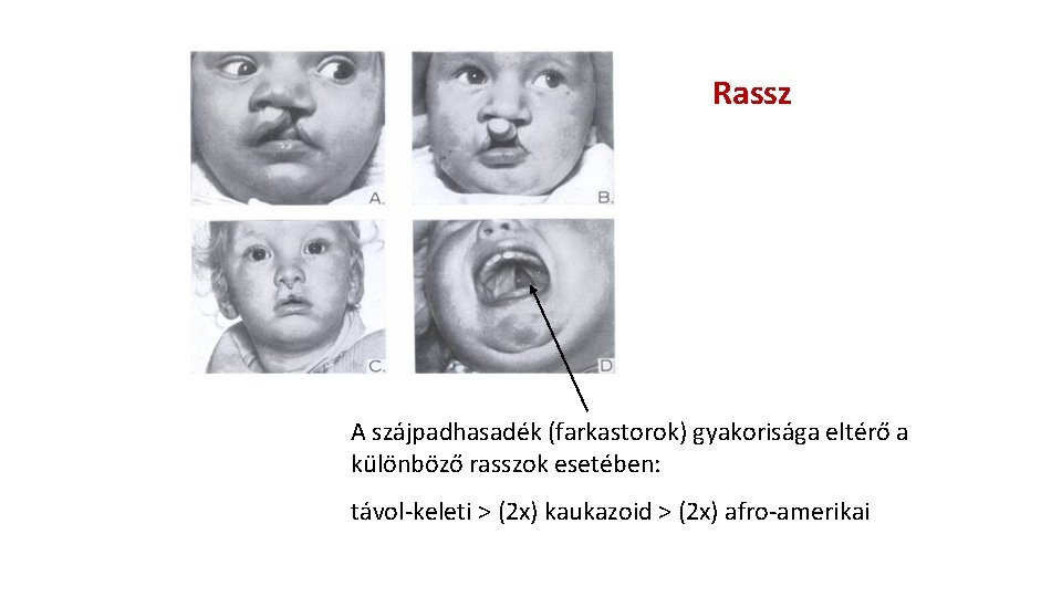 Rassz A szájpadhasadék (farkastorok) gyakorisága eltérő a különböző rasszok esetében: távol-keleti > (2 x)