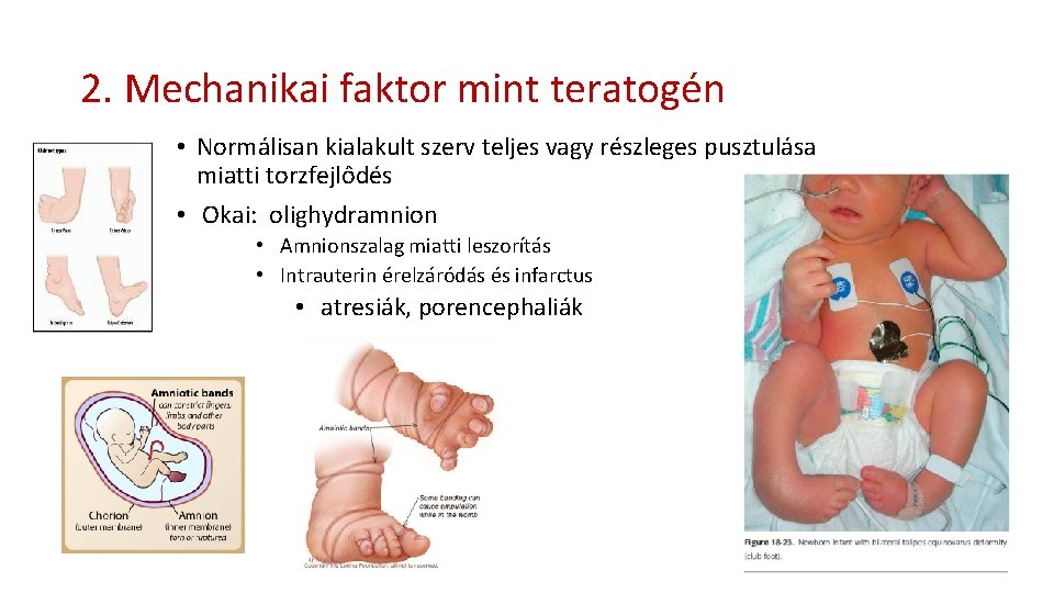 2. Mechanikai faktor mint teratogén • Normálisan kialakult szerv teljes vagy részleges pusztulása miatti