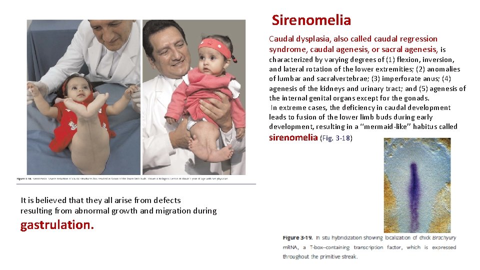 Sirenomelia Caudal dysplasia, also called caudal regression syndrome, caudal agenesis, or sacral agenesis, is