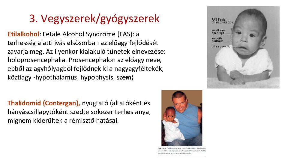 3. Vegyszerek/gyógyszerek Etilalkohol: Fetale Alcohol Syndrome (FAS): a terhesség alatti ivás elsősorban az előagy