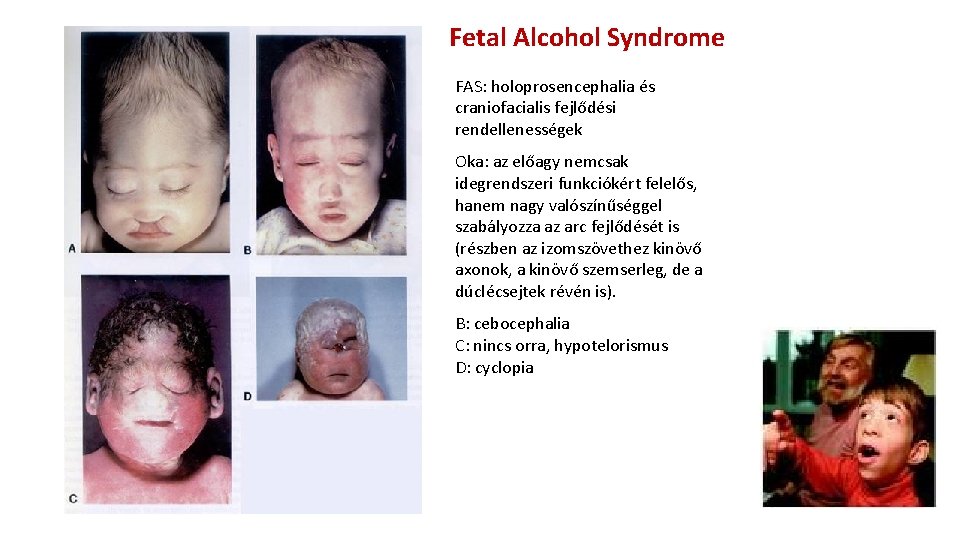 Fetal Alcohol Syndrome FAS: holoprosencephalia és craniofacialis fejlődési rendellenességek Oka: az előagy nemcsak idegrendszeri