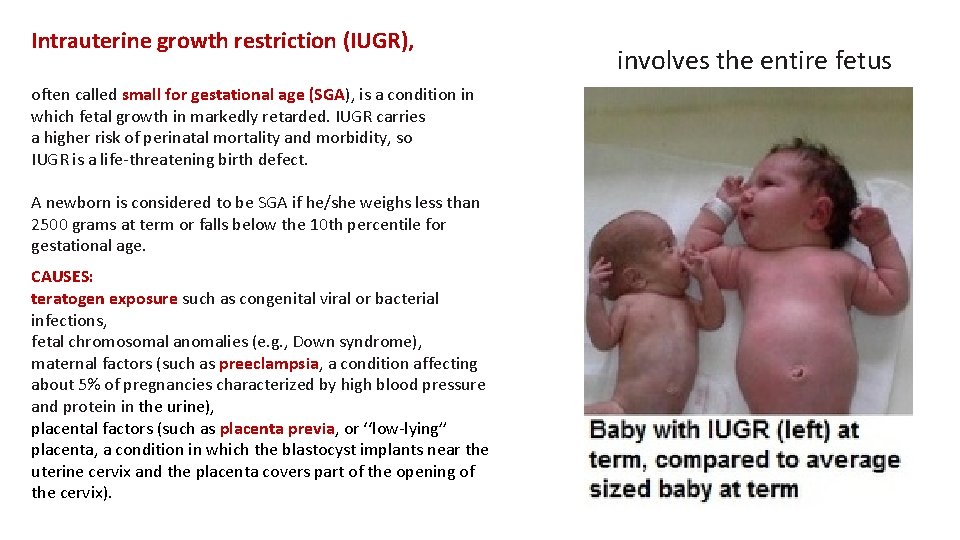 Intrauterine growth restriction (IUGR), often called small for gestational age (SGA), is a condition