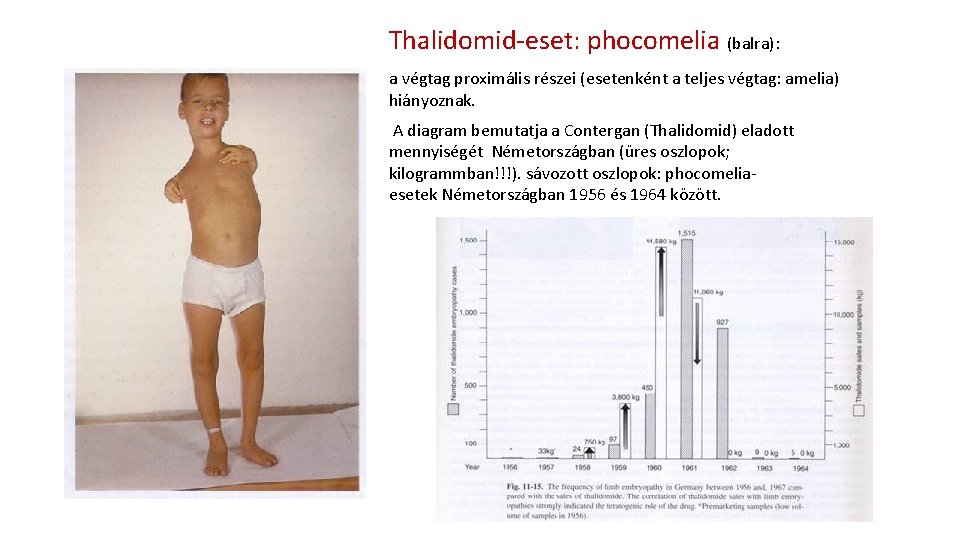 Thalidomid-eset: phocomelia (balra): a végtag proximális részei (esetenként a teljes végtag: amelia) hiányoznak. A