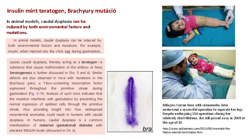 Insulin mint teratogen, Brachyury mutáció In animal models, caudal dysplasia can be induced by