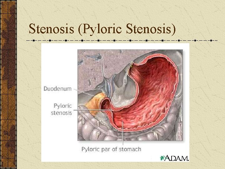 Stenosis (Pyloric Stenosis) 