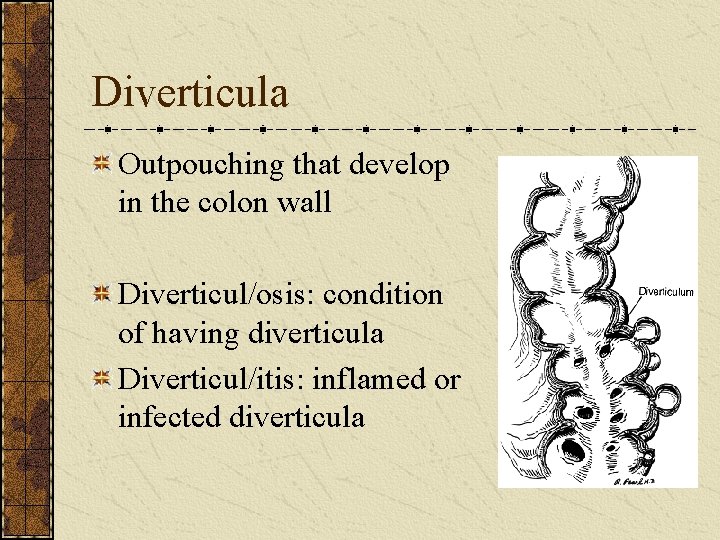 Diverticula Outpouching that develop in the colon wall Diverticul/osis: condition of having diverticula Diverticul/itis: