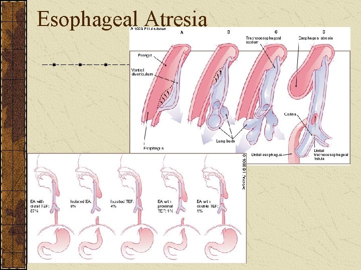 Esophageal Atresia 