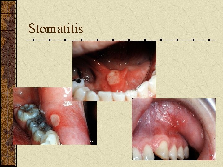 Stomatitis 