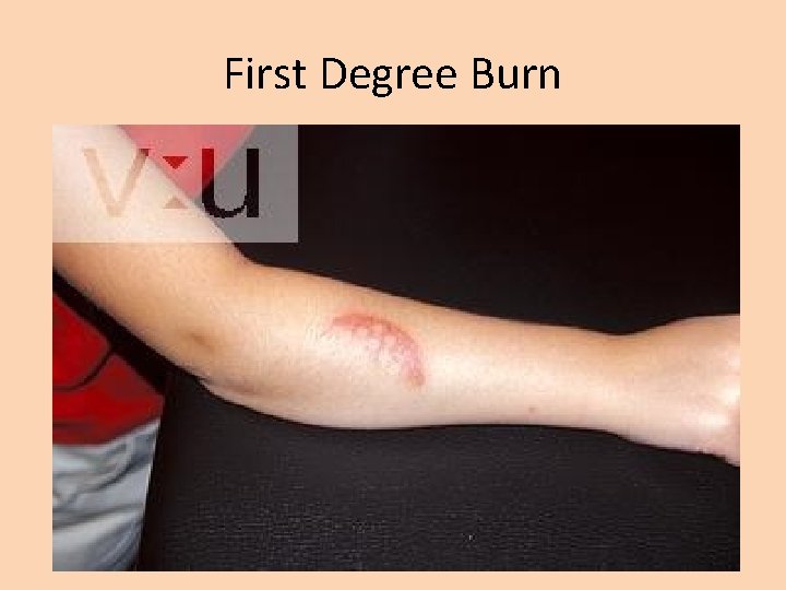 First Degree Burn 