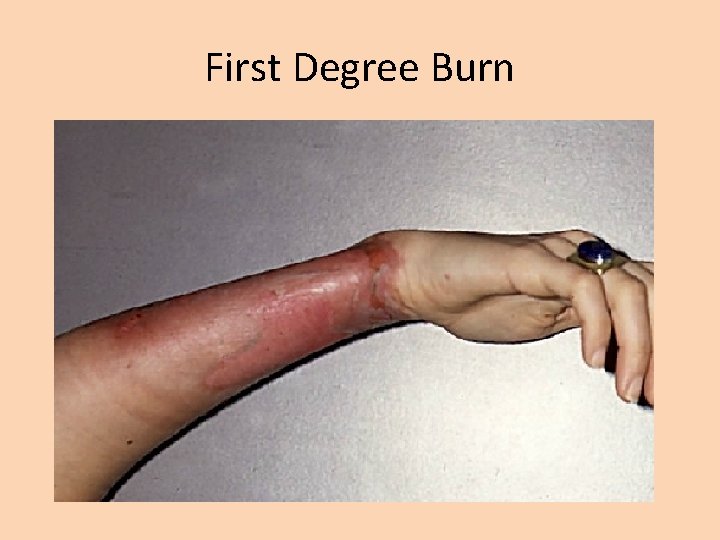 First Degree Burn 