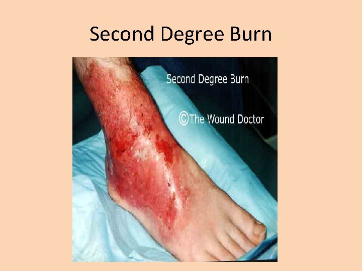 Second Degree Burn 