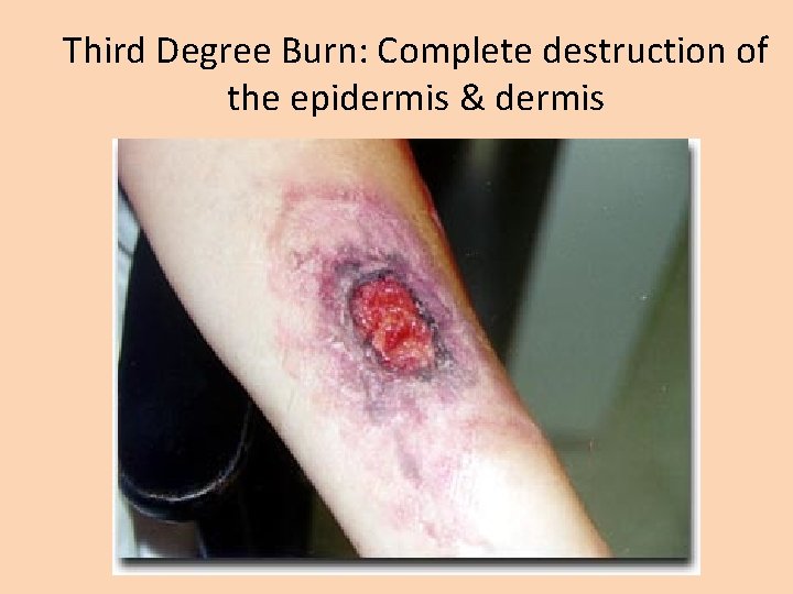 Third Degree Burn: Complete destruction of the epidermis & dermis 