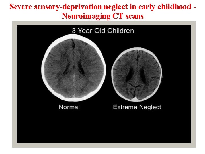 Severe sensory-deprivation neglect in early childhood - Neuroimaging CT scans © Crown copyright 2005