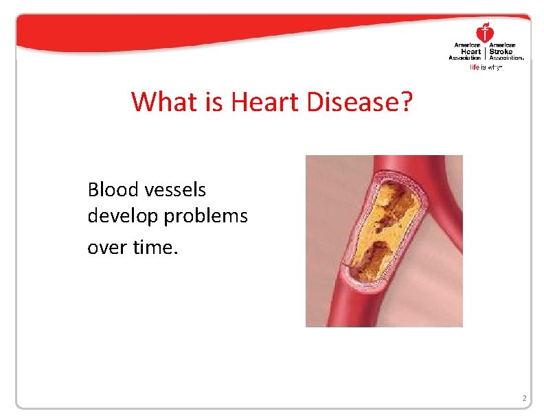 What is Heart Disease? Blood vessels develop problems over time. 2 