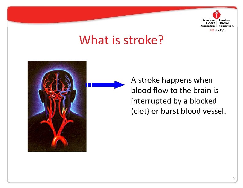 What is stroke? A stroke happens when blood flow to the brain is interrupted