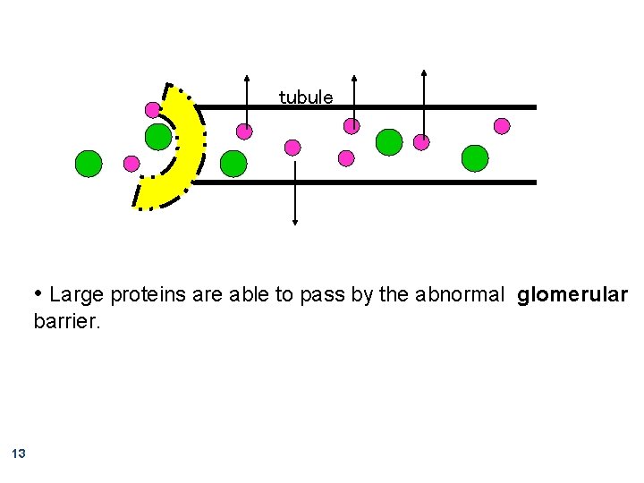 tubule • Large proteins are able to pass by the abnormal glomerular barrier. 13