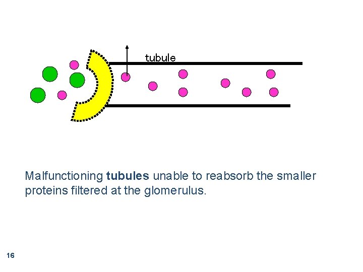 tubule Malfunctioning tubules unable to reabsorb the smaller proteins filtered at the glomerulus. 16