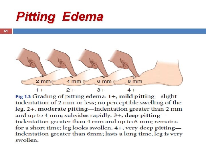 Pitting Edema 61 