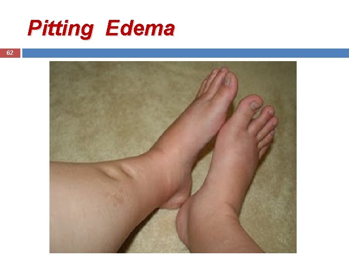 Pitting Edema 62 