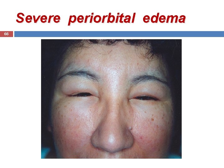 Severe periorbital edema 66 