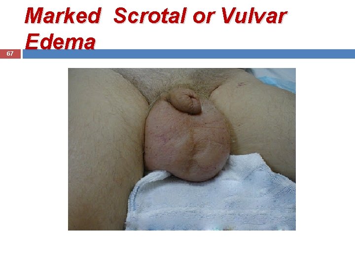 67 Marked Scrotal or Vulvar Edema 
