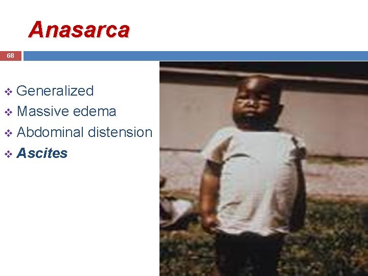 Anasarca 68 Generalized v Massive edema v Abdominal distension v Ascites v 