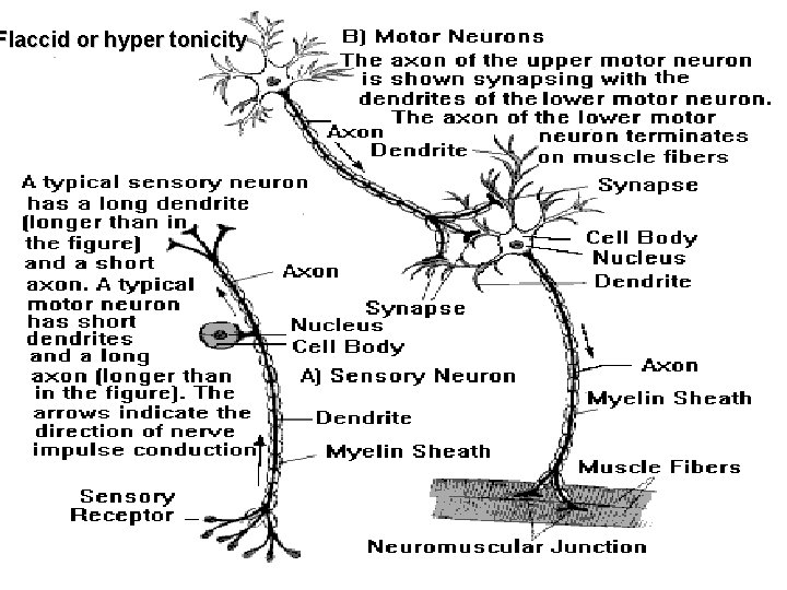 Flaccid or hyper tonicity Flaccid or hyper tonicity