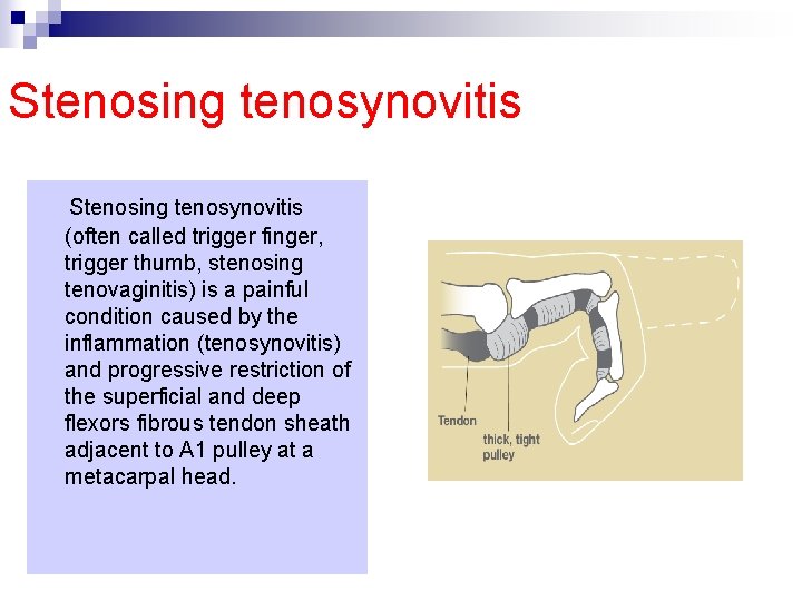 Stenosing tenosynovitis (often called trigger finger, trigger thumb, stenosing tenovaginitis) is a painful condition