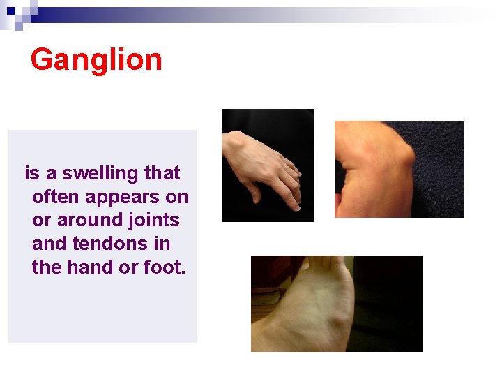 Ganglion is a swelling that often appears on or around joints and tendons in
