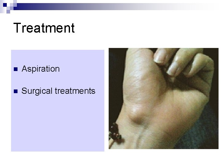 Treatment n Aspiration n Surgical treatments 