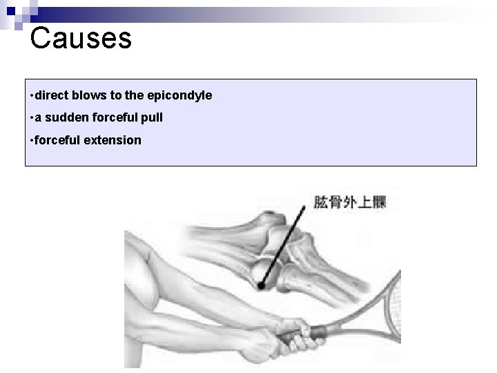 Causes • direct blows to the epicondyle • a sudden forceful pull • forceful