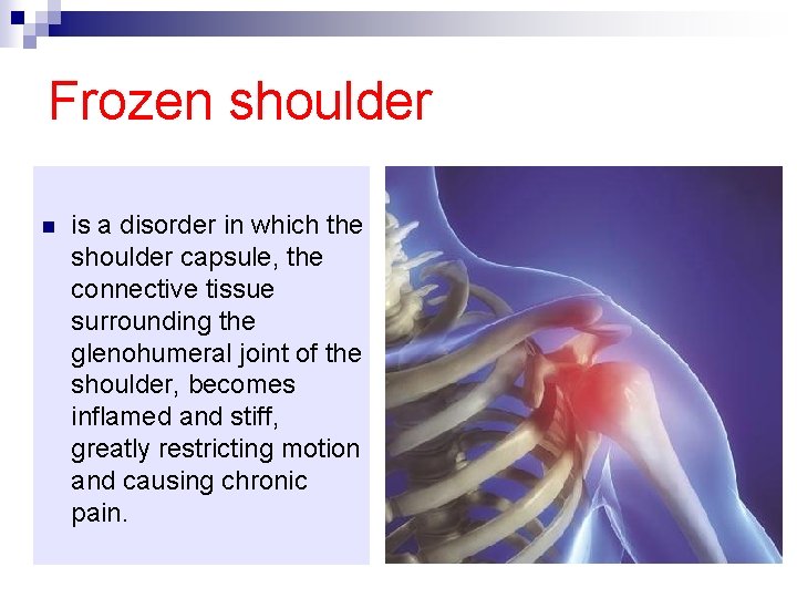 Frozen shoulder n is a disorder in which the shoulder capsule, the connective tissue