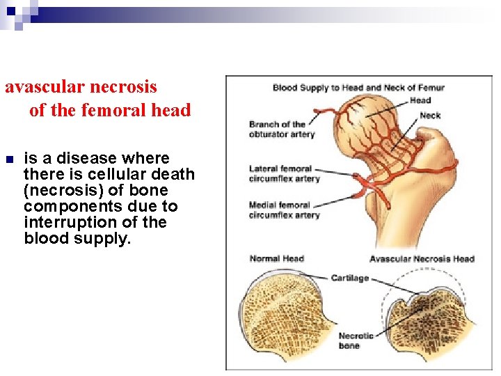 avascular necrosis of the femoral head n is a disease where there is cellular