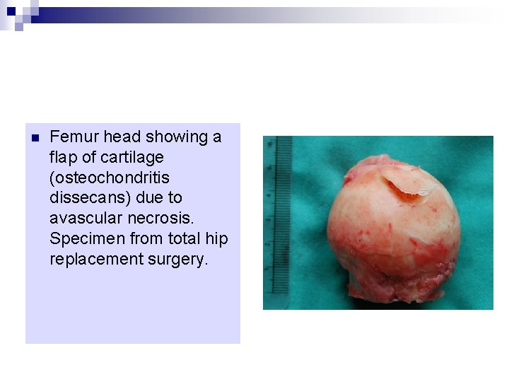 n Femur head showing a flap of cartilage (osteochondritis dissecans) due to avascular necrosis.