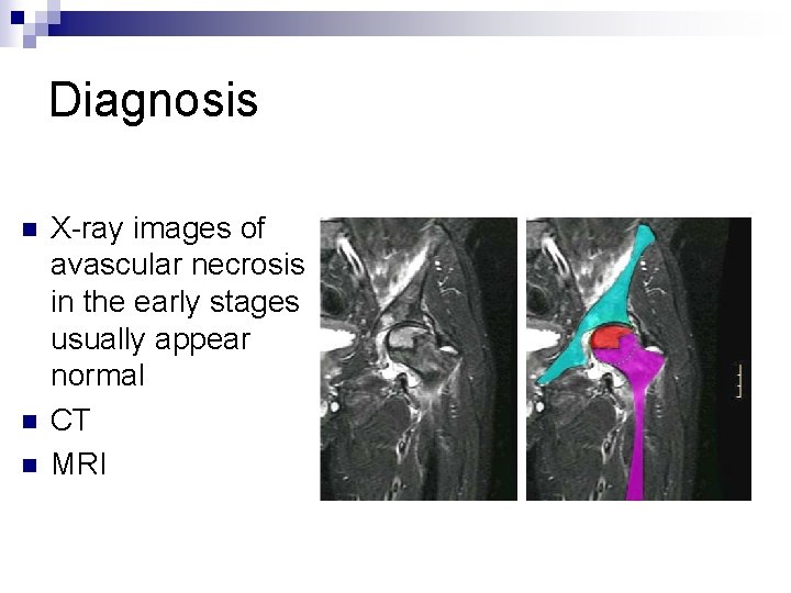 Diagnosis n n n X-ray images of avascular necrosis in the early stages usually