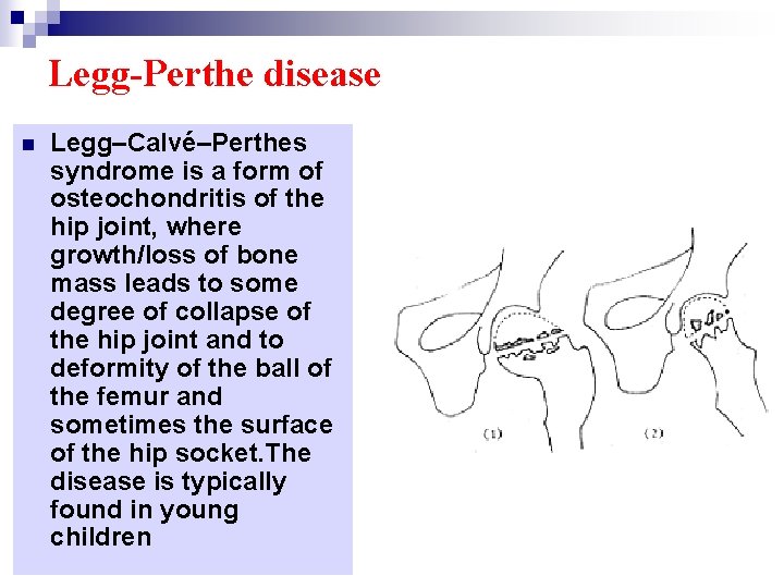 Legg-Perthe disease n Legg–Calvé–Perthes syndrome is a form of osteochondritis of the hip joint,