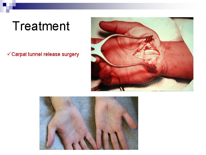 Treatment üCarpal tunnel release surgery 
