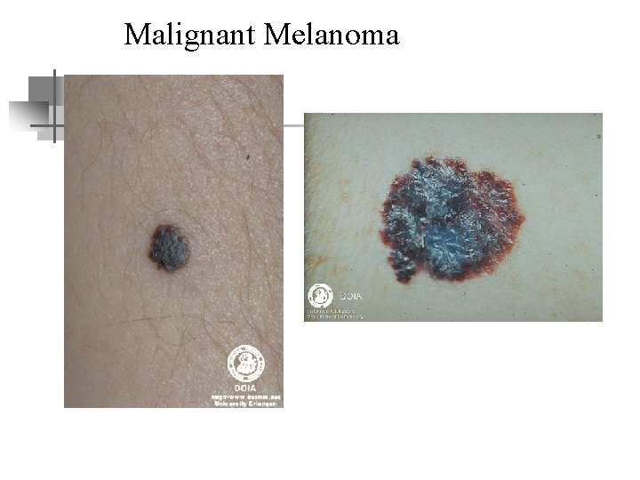 Malignant Melanoma 