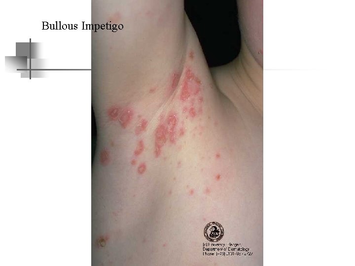 Bullous Impetigo 