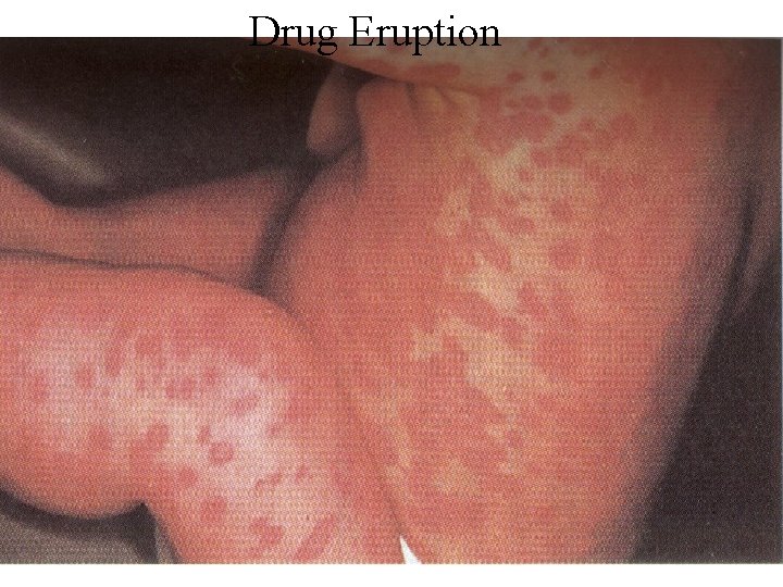 Drug Eruption 