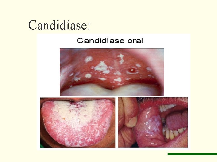 Candidíase: 