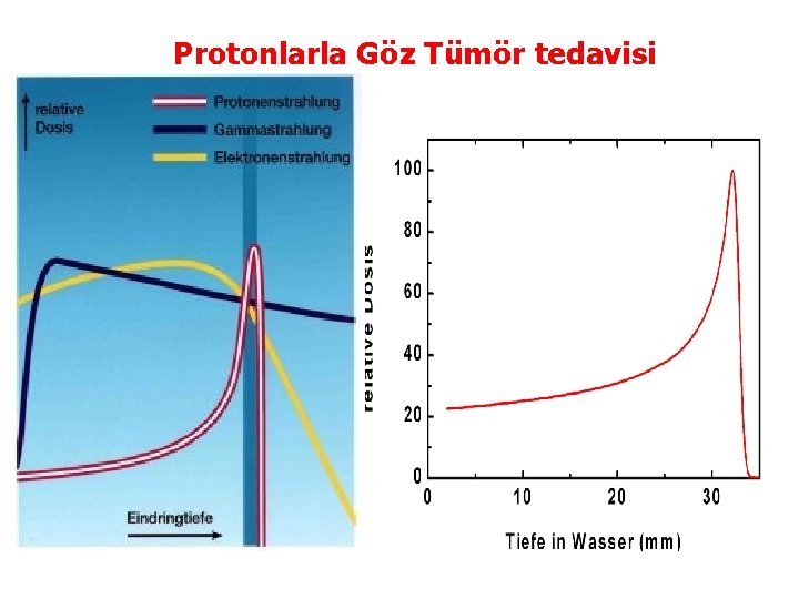 Protonlarla Göz Tümör tedavisi 