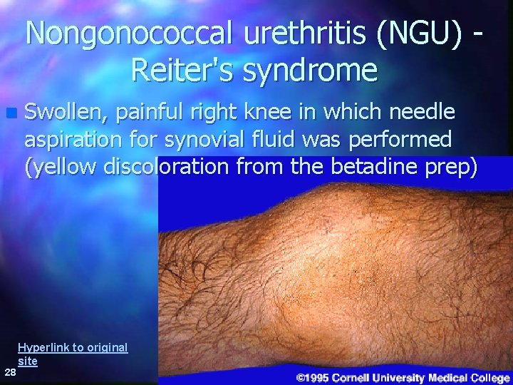 Nongonococcal urethritis (NGU) Reiter's syndrome n 28 Swollen, painful right knee in which needle