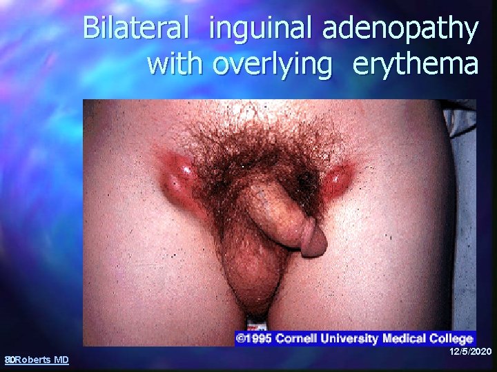 Bilateral inguinal adenopathy with overlying erythema R 30 Roberts MD 12/5/2020 