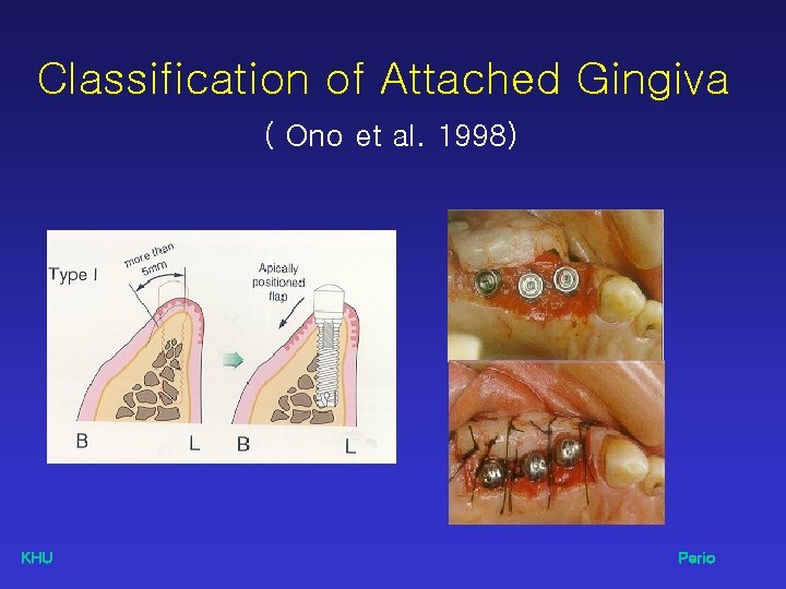 Classification of Attached Gingiva ( Ono et al. 1998) KHU Perio 