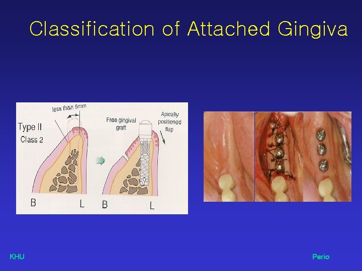 Classification of Attached Gingiva KHU Perio 