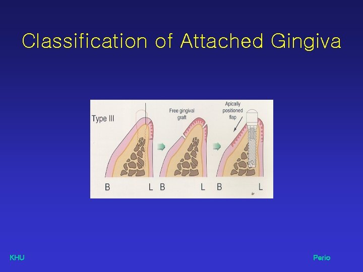Classification of Attached Gingiva KHU Perio 