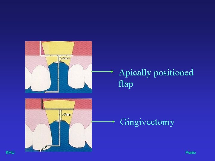 Apically positioned flap Gingivectomy KHU Perio 