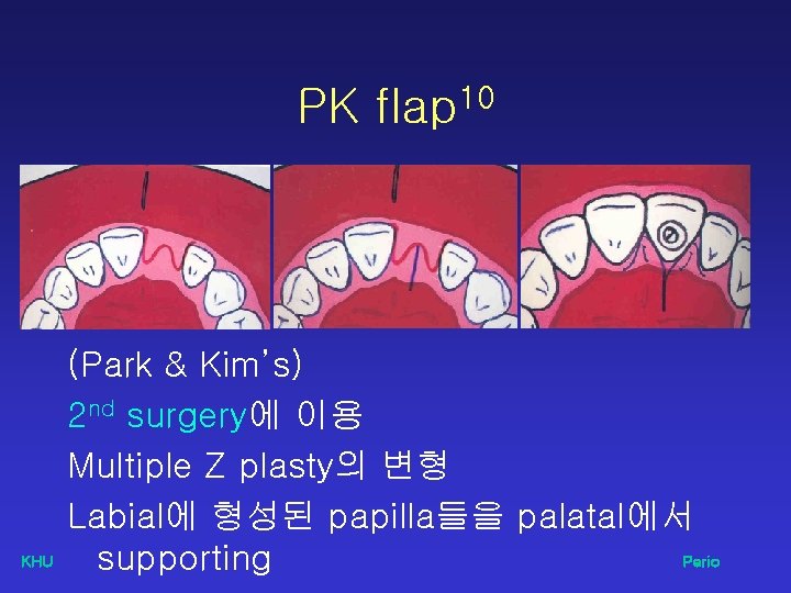 PK flap 10 KHU (Park & Kim’s) 2 nd surgery에 이용 Multiple Z plasty의