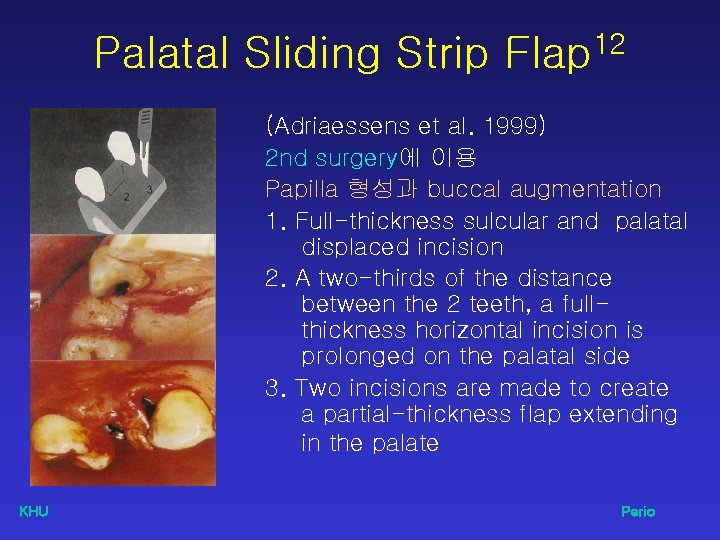 Palatal Sliding Strip Flap 12 (Adriaessens et al. 1999) 2 nd surgery에 이용 Papilla